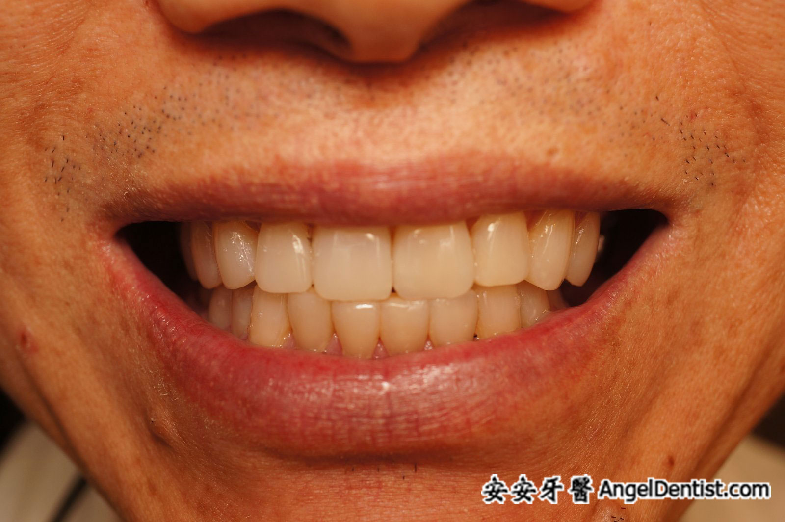 安安牙醫 Angel Dentist 門牙整形 快速矯正 全瓷牙冠 全瓷貼面 牙齒美白 